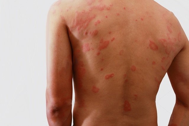 Janeiro Roxo alerta para prevenção, diagnóstico precoce e combate ao preconceito da hanseníase Janeiro Roxo alerta para prevenção, diagnóstico precoce e combate ao preconceito da hanseníase